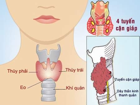 Bị thay đổi giọng, mất giọng sau phẫu thuật tuyến giáp!